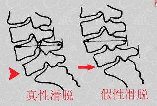 1509435990199495.jpg 腰椎滑脱15.jpg