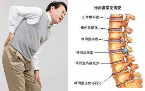 1509592534126147.jpg 腰椎滑脱11.jpg