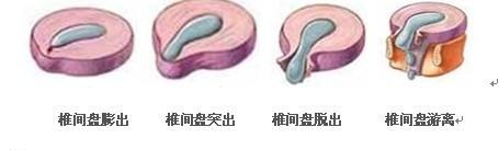 腰椎间盘膨出 腰椎间盘膨出