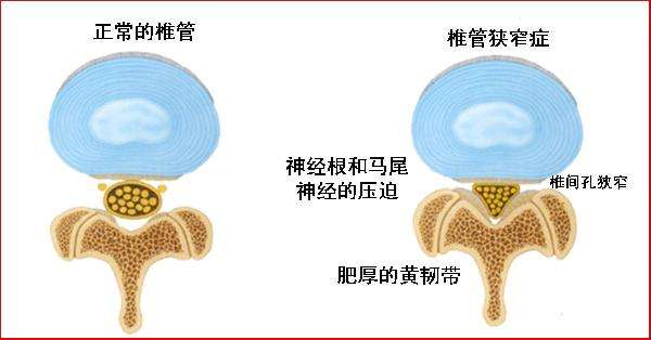 1509953847578433.jpg 椎管狭窄.jpg