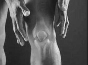 继发性骨关节炎 继发性骨关节炎