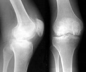 骨质增生药物治疗 骨质增生药物治疗