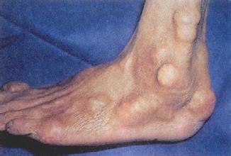 急性痛风 急性痛风