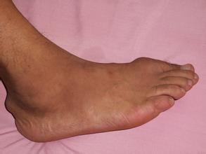 痛风结石 痛风结石