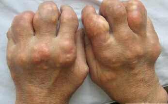 1510716592575722.jpg 痛风1 (2).jpg