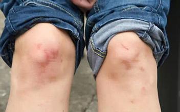 感冒后注意预防滑膜炎 感冒后注意预防滑膜炎