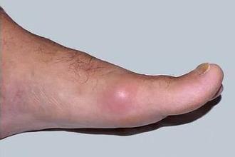 急性痛风的处理方法 急性痛风的处理方法