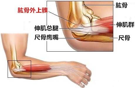 1511591735239299.jpg 网球肘5.jpg