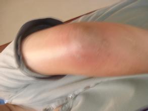 1511852692127163.jpg 滑膜炎.jpg