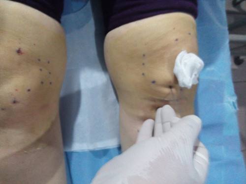 小针刀治疗膝关节炎 小针刀治疗膝关节炎