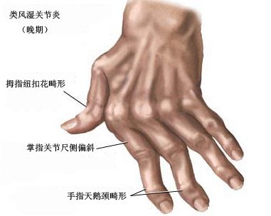 1512031940456309.jpg 风湿11.jpg