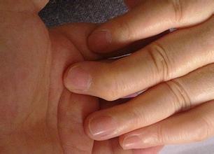 类风湿可导致手指不灵活 类风湿可导致手指不灵活