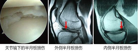1512270315927550.jpg 半月板1.jpg