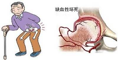 1512359783218171.jpg 股骨头4.jpg