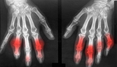 1516589273402261.jpg 痛风1.jpg