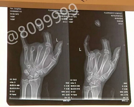 1520579633387287.jpg 受伤手指.jpg