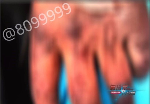 1525056907139668.jpg 2患者伤情1.jpg