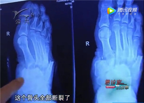 1527747427378851.jpg 脚掌片子.jpg