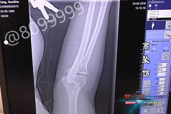 1537165278111009.jpg 骨折_副本.jpg