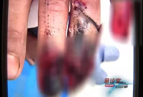 1540784062867606.jpg 小吴受伤的手指.jpg